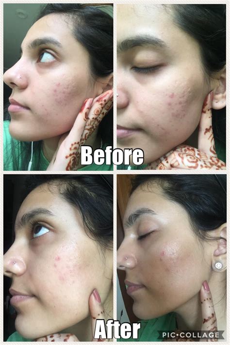 dior vitamin c for dermarolling|before and after dermaroller toner.